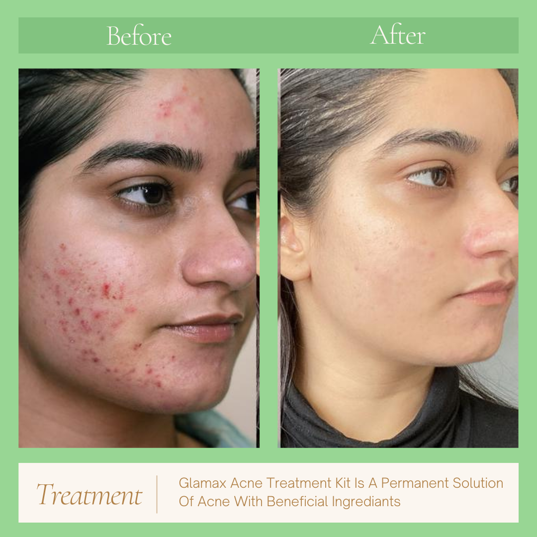 Buy Acne Serum and Get Free Acne Facewash – Clear Skin Solution & Best Acne Treatment